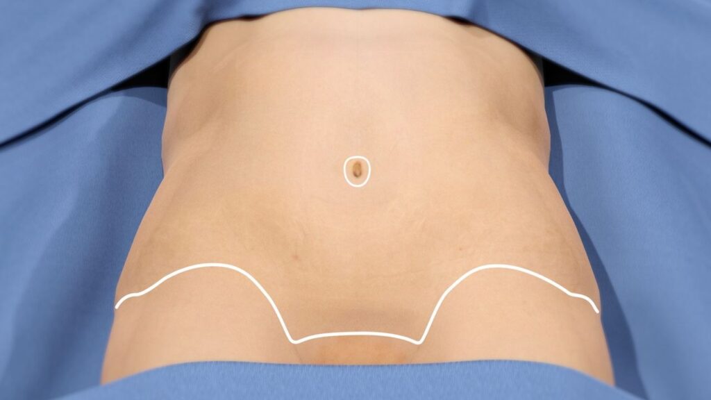 Discover the Secrets to a Flatter Belly: Your Ultimate Guide to Tummy Tuck in Dubai